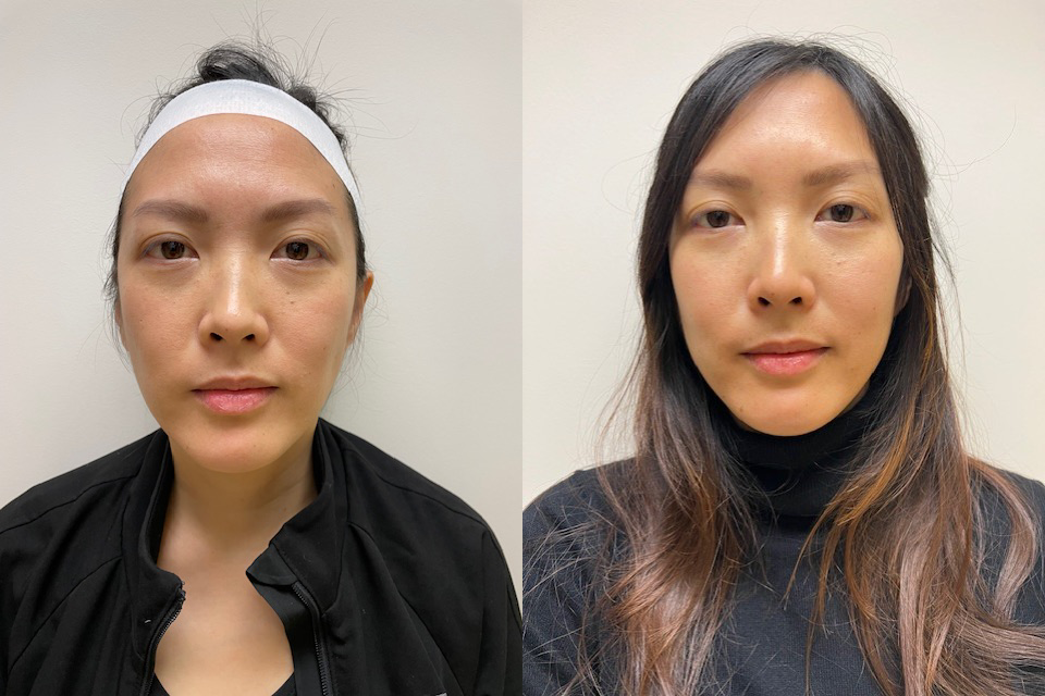 Botox before and after photo by Semel Vision Care & Aesthetics in El Segundo, CA