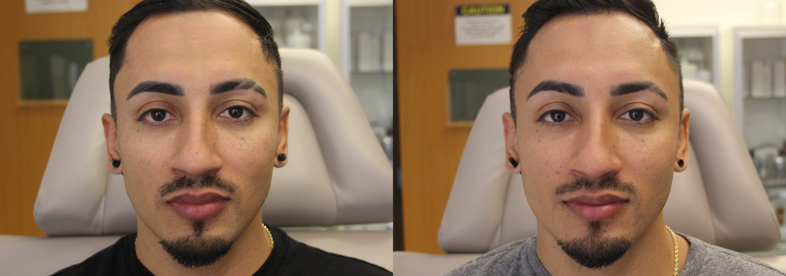 Jeuveau before and after photo by Semel Vision Care & Aesthetics in El Segundo, CA