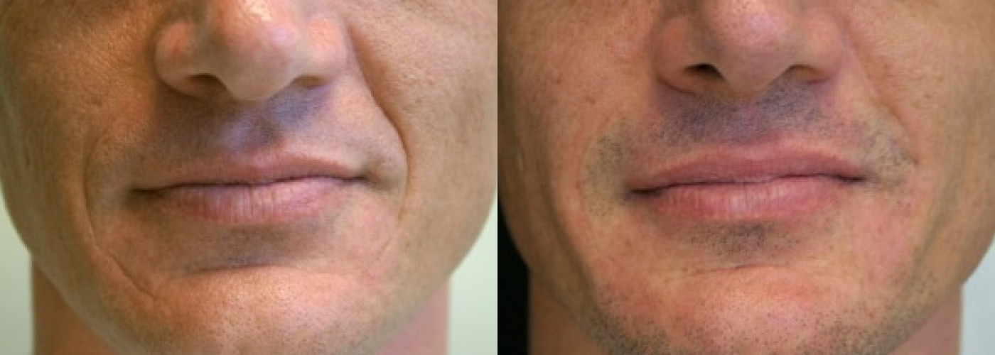 Fillers before and after photo by Semel Vision Care & Aesthetics in El Segundo, CA