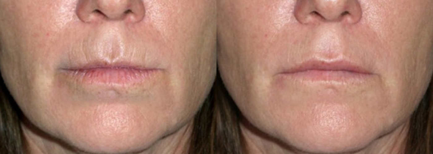 Fillers before and after photo by Semel Vision Care & Aesthetics in El Segundo, CA