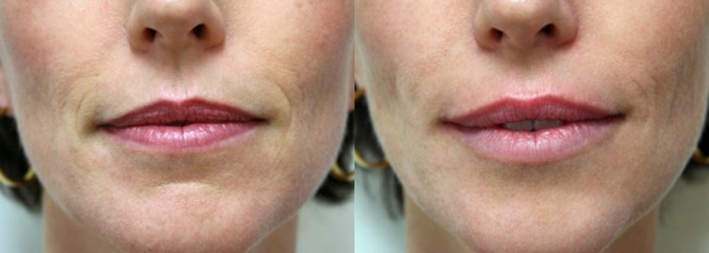 Lip Filler before and after photo by Semel Vision Care & Aesthetics in El Segundo, CA