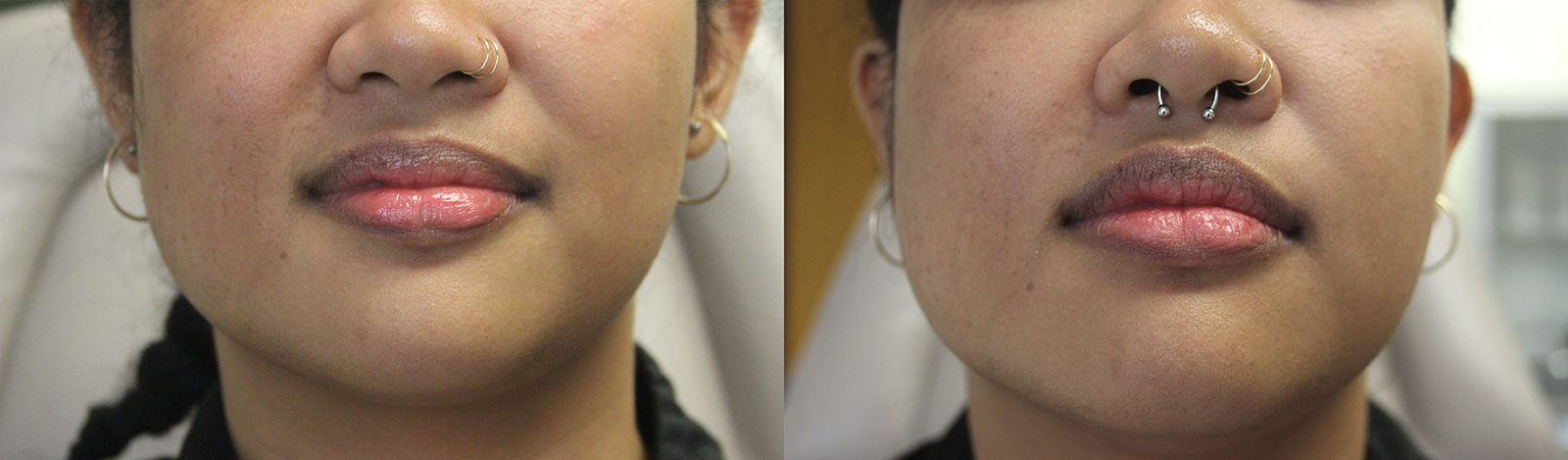 Lip Filler before and after photo by Semel Vision Care & Aesthetics in El Segundo, CA
