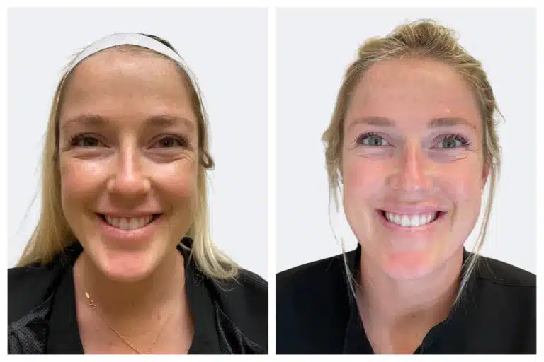botox before and after results by semel aesthetics