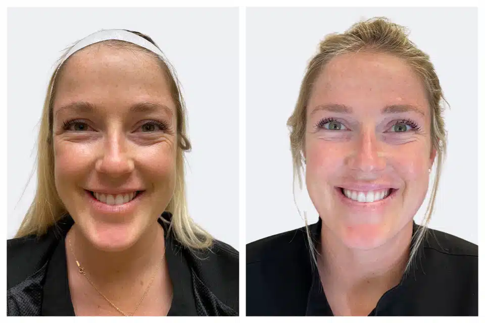 botox before and after results by semel aesthetics botox before and after results by semel aesthetics