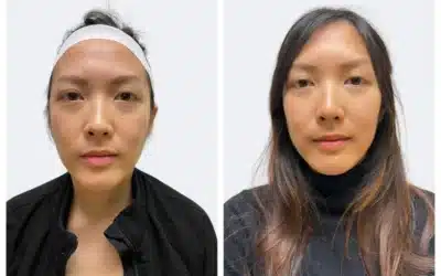 botox before and after results by semel aesthetics