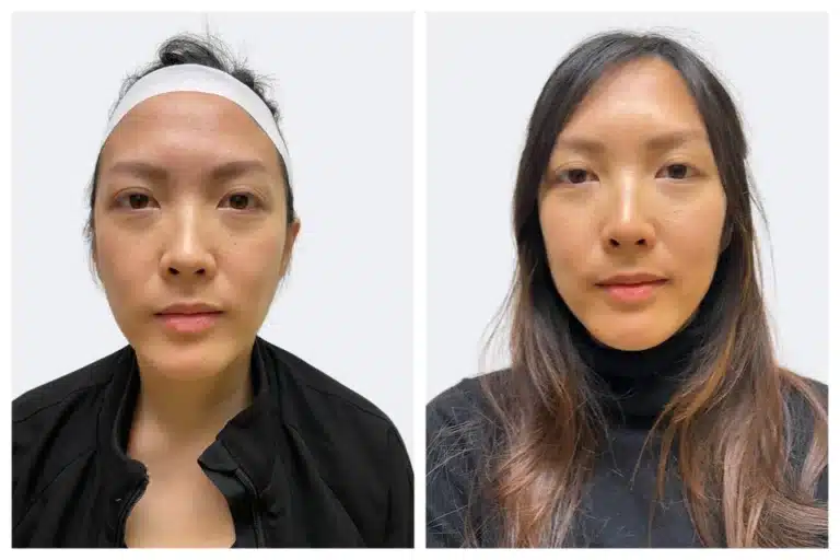 botox before and after results by semel aesthetics