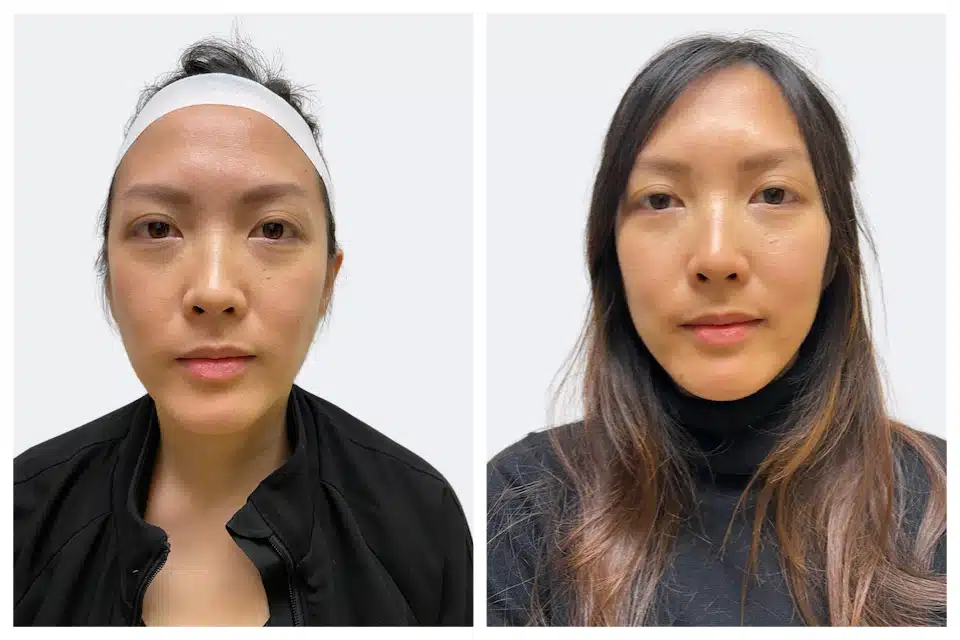 botox before and after results by semel aesthetics botox before and after results by semel aesthetics
