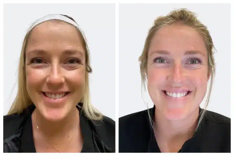 botox forehead lines before and after results Before and after front-view comparison of a smiling blonde patient demonstrating smoothed forehead lines and reduced fine wrinkles after Botox treatment